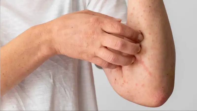 Sarampión en el Perú: Puno registra 16 casos confirmados y 42 sospechosos, aseguró el gobernador regional