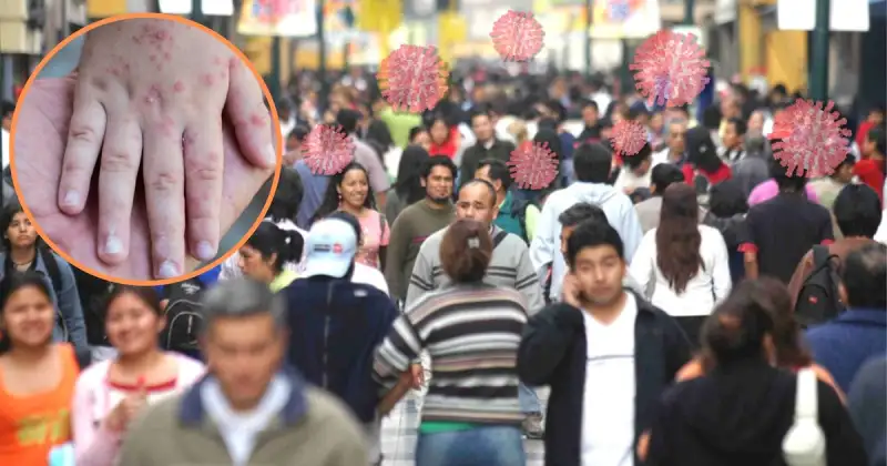 El Perú declara emergencia sanitaria por brote de sarampión en Lima, el Callao y otras 12 regiones