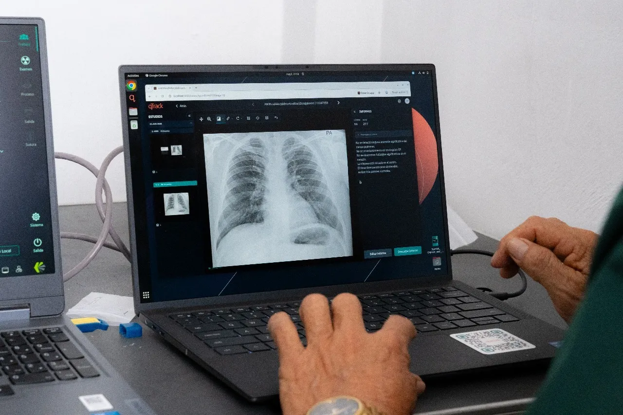 IA del Minsa contra la tuberculosis